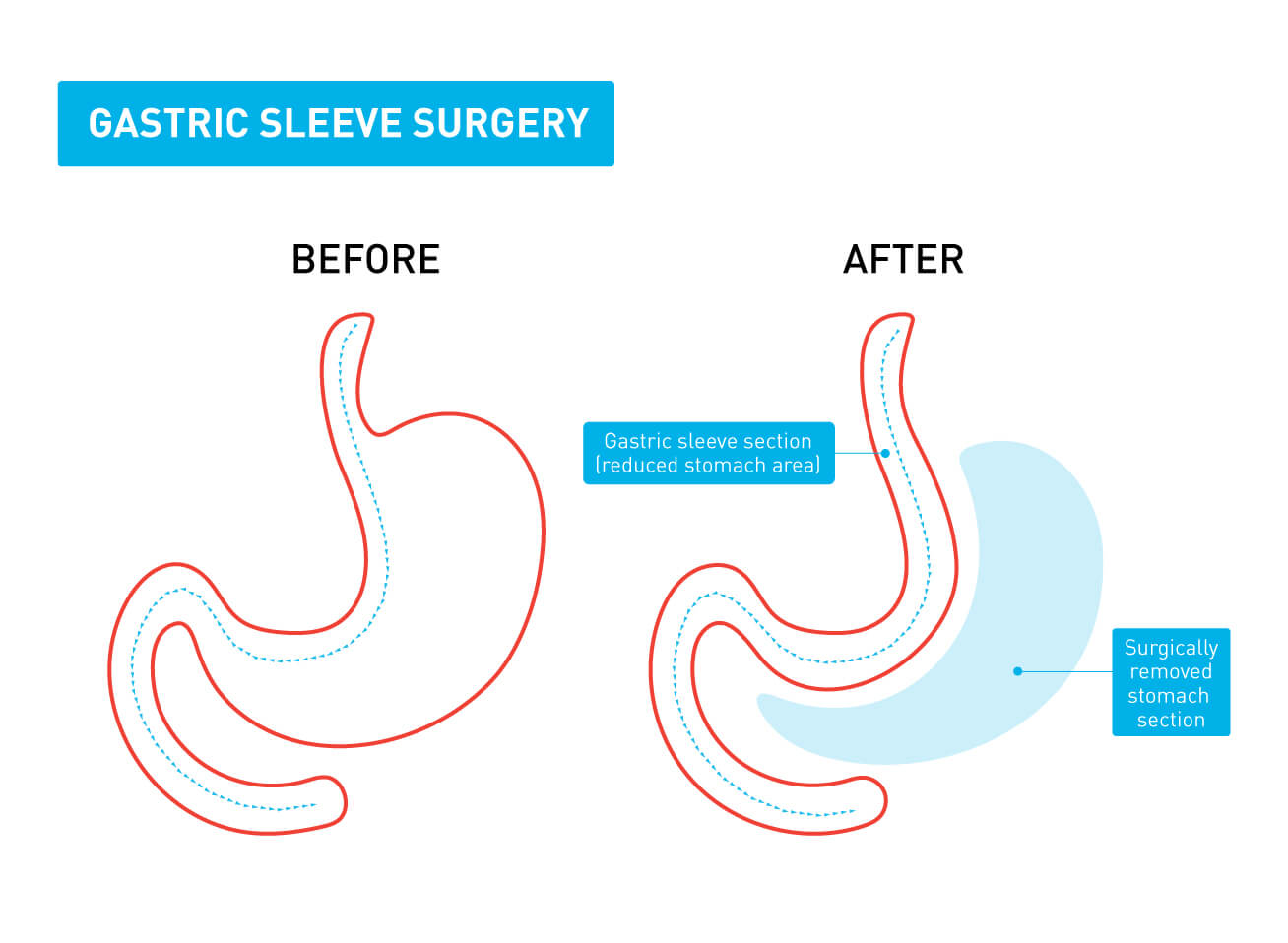 A graphic showing the difference between a stomach before and after gastric sleeve surgery