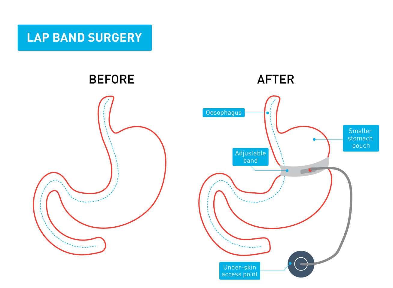 A graphic showing the difference between a stomach before and after lap band surgery
