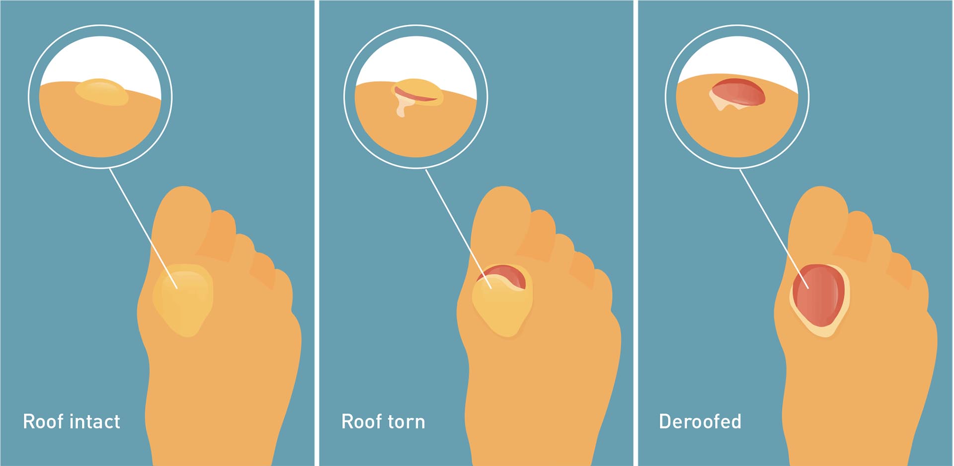 Thick Toenails: Cause, Symptoms & Treatment - Blister Prevention - Rebecca  Rushton