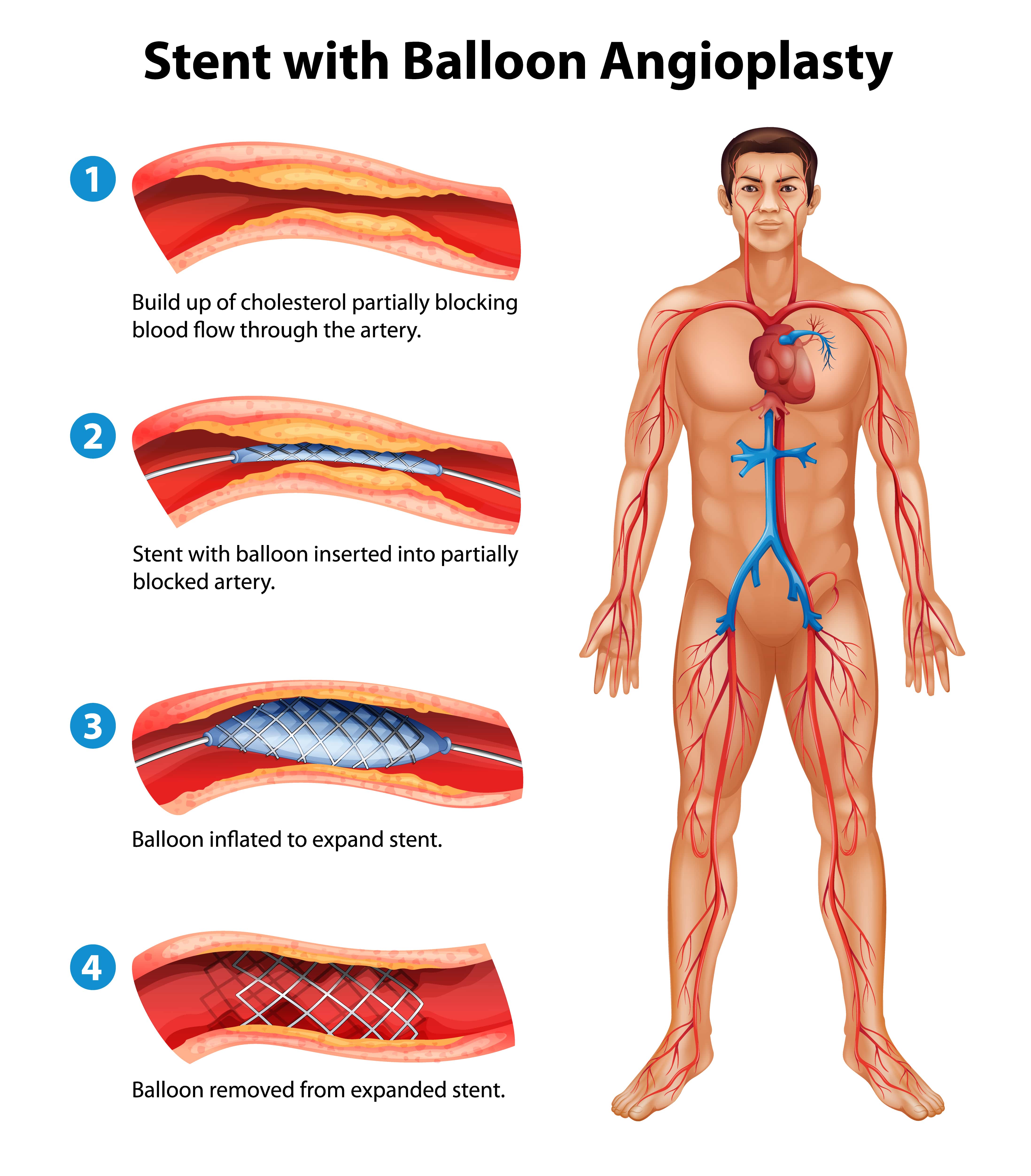 The cardiologist inserts a small deflated balloon through a main artery in your groin or wrist, and moves it to the heart’s artery. The balloon is inflated inside the narrowed part of your artery. In most cases, the cardiologist may use a stent to keep the artery open.