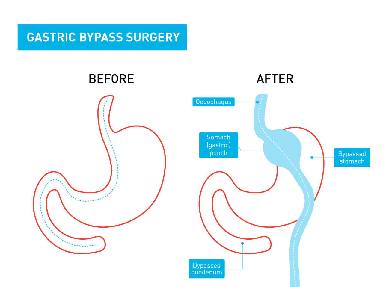 A graphic showing the difference between a stomach before and after gastric bypass surgery